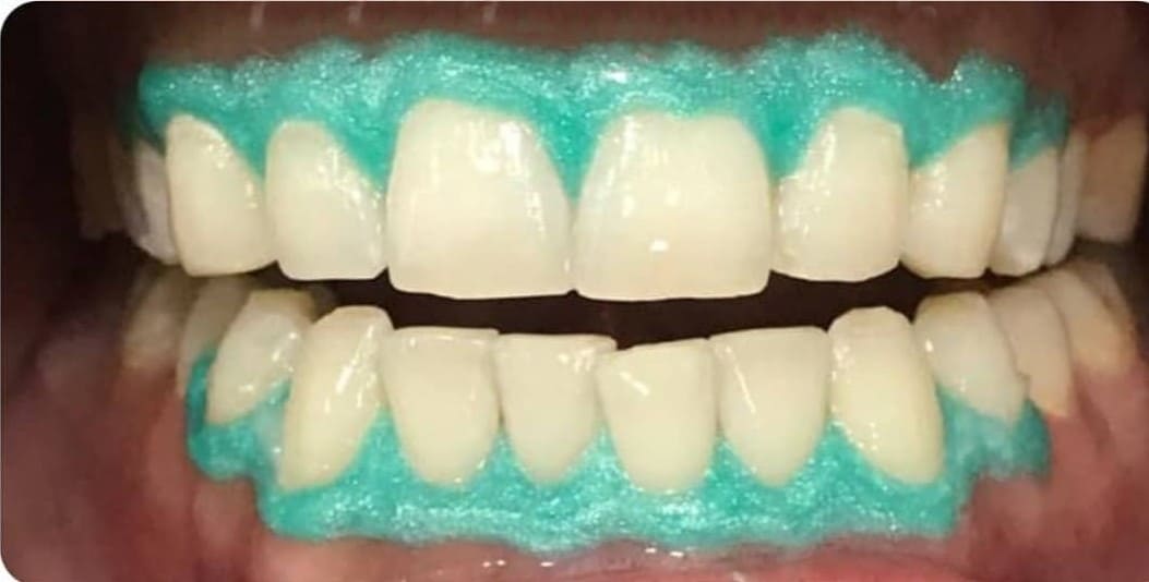 After Professional Teeth Whitening 6