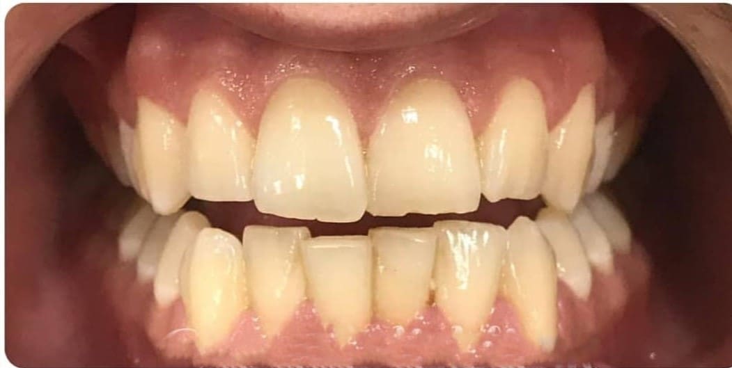 Before Professional Teeth Whitening 7