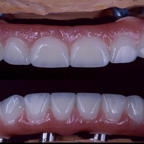 About All On 4 Dental Implants