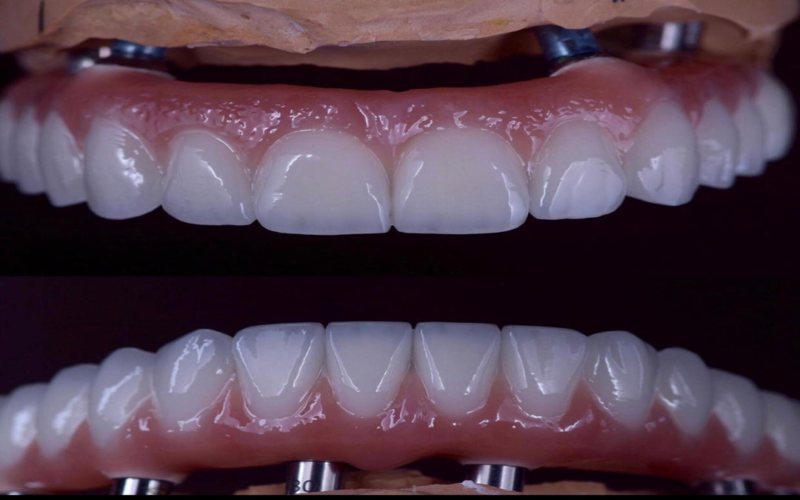 All on 4 implant tedavisi hakkında