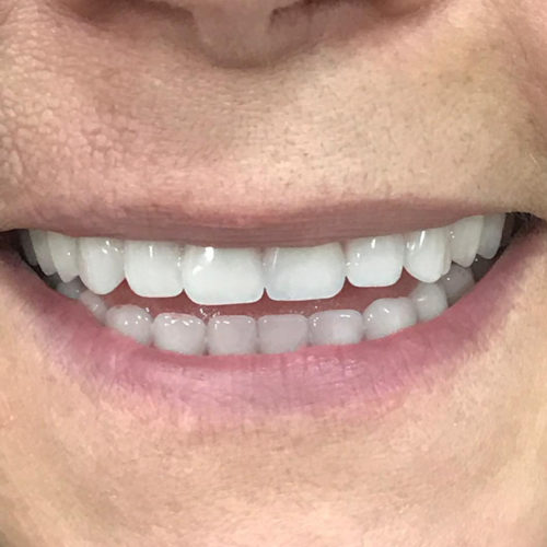 About Cosmetic Dentures