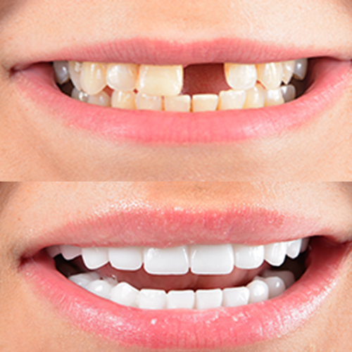 About Dental Bridges