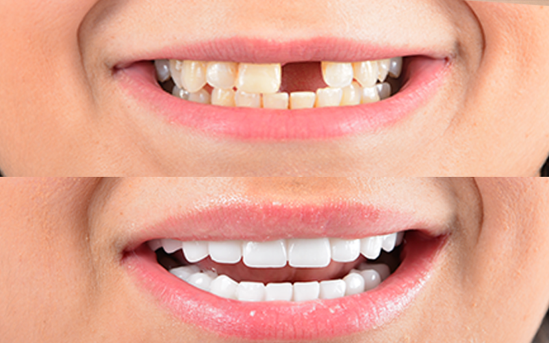 About Dental Bridges