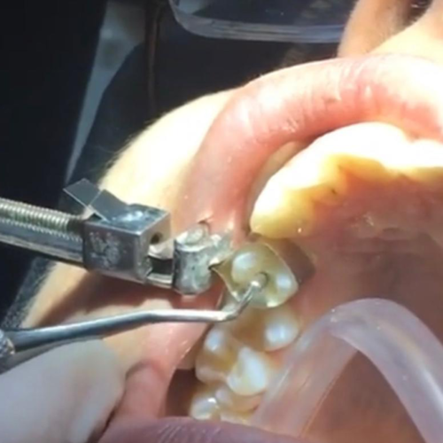 About Dental Fillings