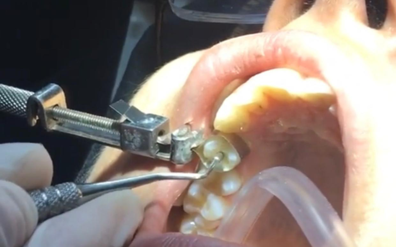 About Dental Fillings