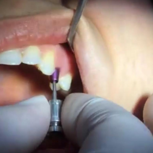 About Dental Implants