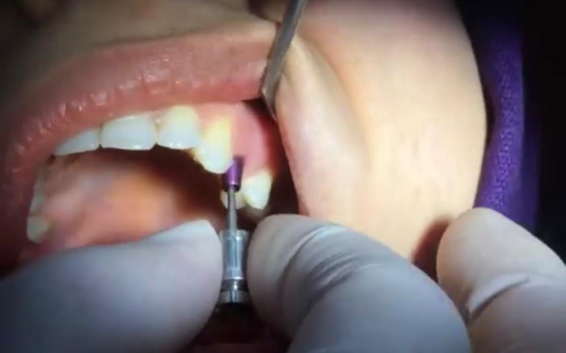 About Dental Implants