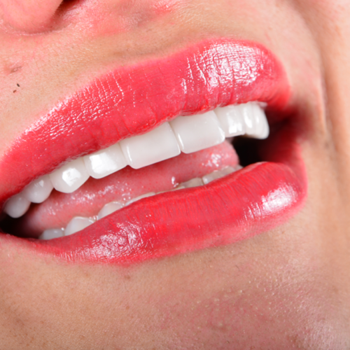 About Dental Lumineers