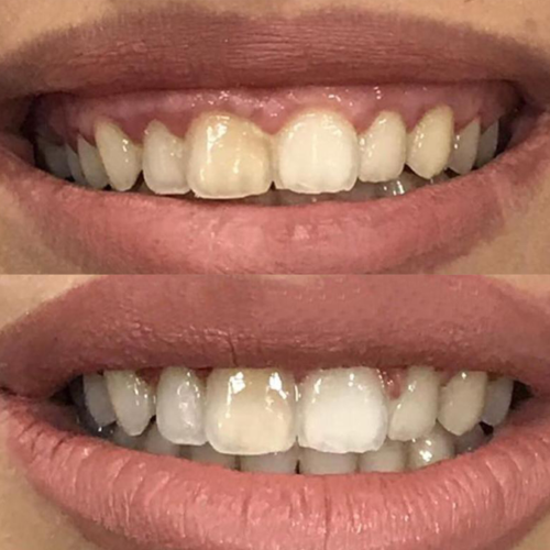 About Gum Contouring