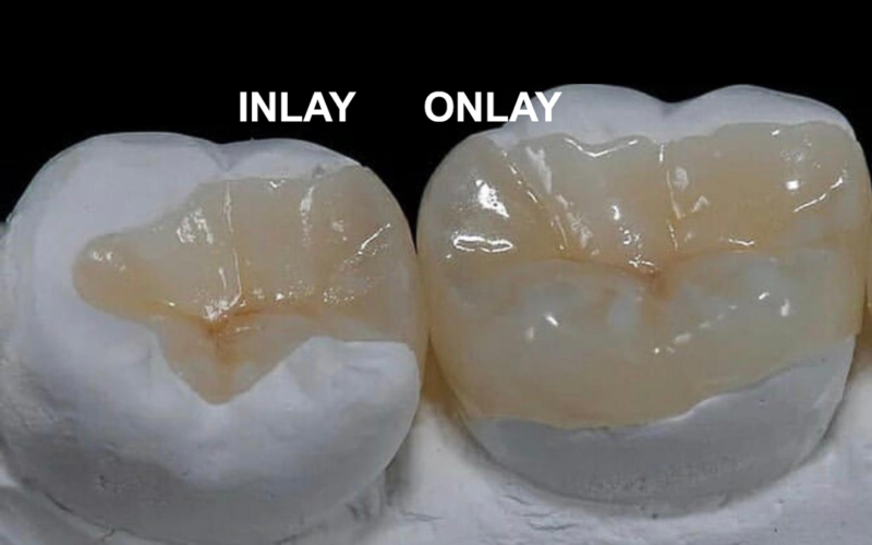 İnley ve Onley Hakkında