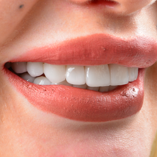 About Laminate Veneers
