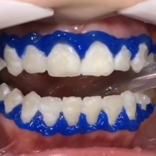 About Professional Teeth Whitening