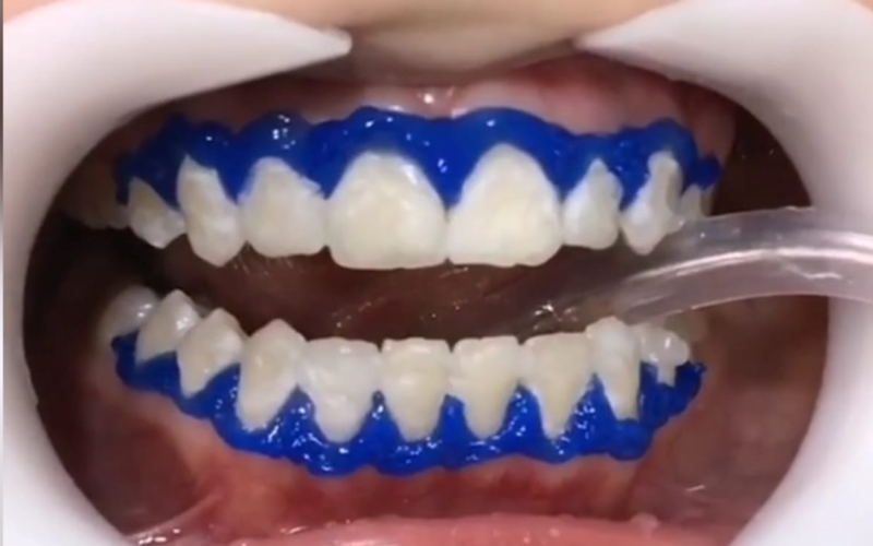 About Professional Teeth Whitening