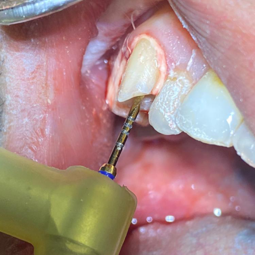 About Root Canal Treatment