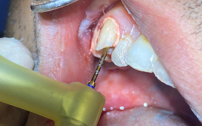 About Root Canal Treatment