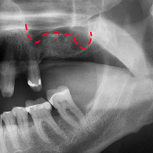 About Sinus Lifting Treatment