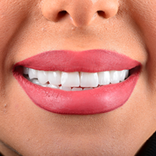 About Smile Makeover