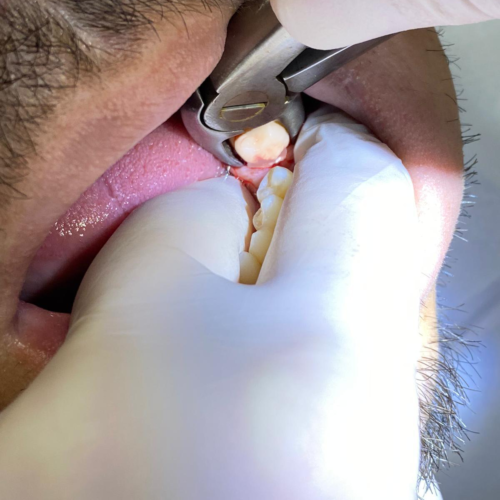 About Tooth Extraction