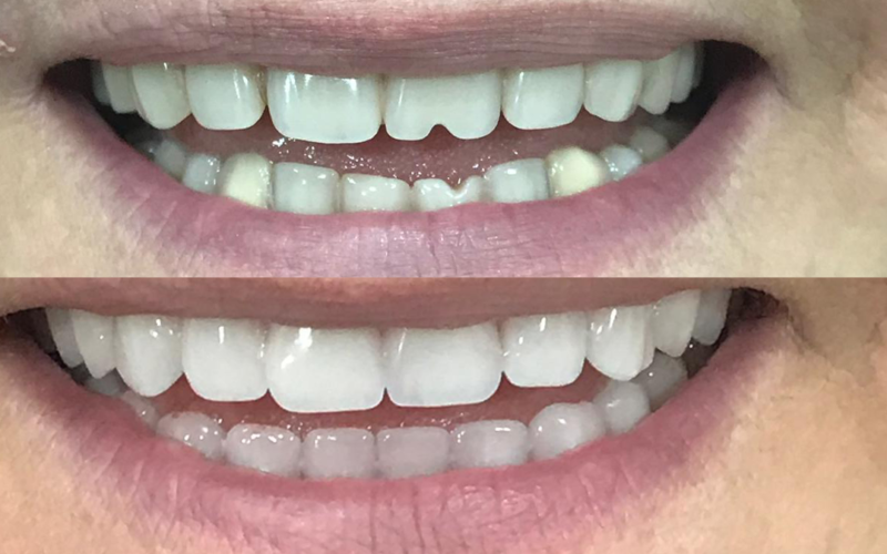 Cosmetic Dentures Before After