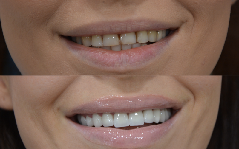 Dental Crowns Before After