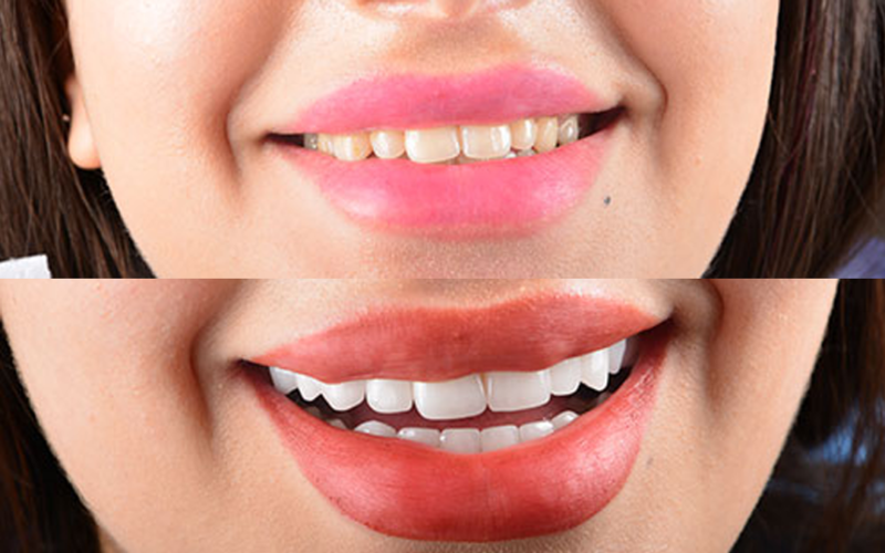 Laminate Veneers Before After