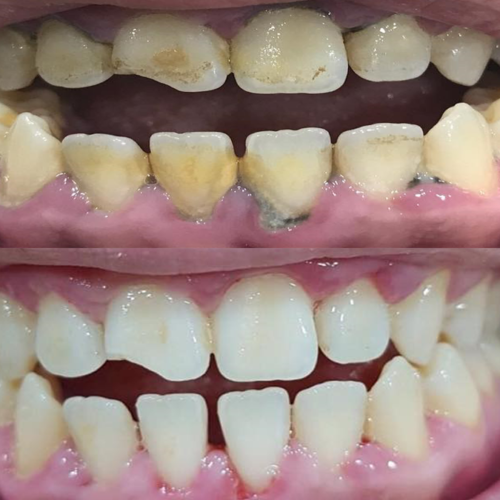 Scale and Polish Before After