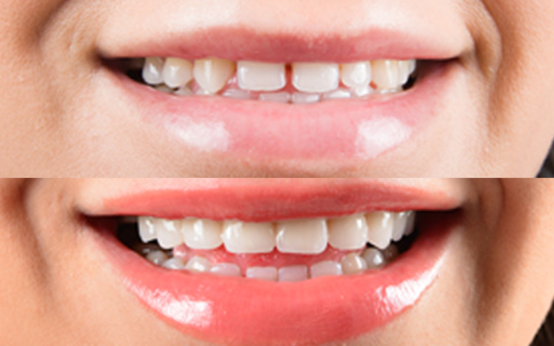 Smile Makeover Before After