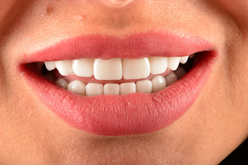 Dental Travel Turkey Dental Lumineers