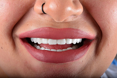 Dental Travel Turkey Laminate Veneer