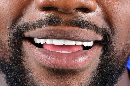 Dental Travel Turkey Smile Makeover